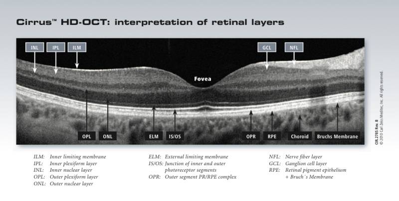 cirrus_oct_interpretion_of_retinal_layers.jpg cirrus_oct_interpretion_of_retinal_layers.jpg
