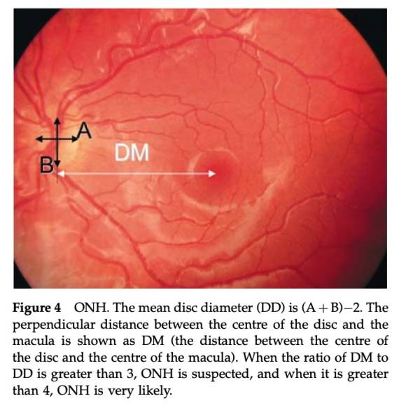 DD:DM ratio measurements DD:DM ratio measurements